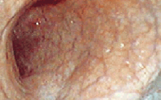 Антральный гастрит — воспаление в антруме желудка