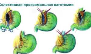 Язвенная болезнь желудка: история и новый подход к лечению