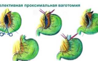 Язвенная болезнь желудка: история и новый подход к лечению