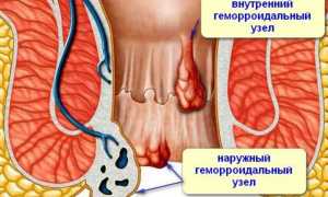 Геморрой комбинированный: причины и лечение