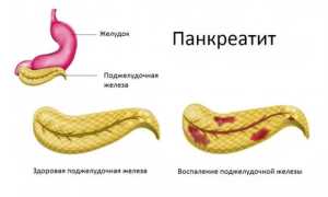 Как остановить понос на фоне панкреатита: советы и рекомендации