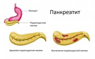 Как остановить понос на фоне панкреатита: советы и рекомендации