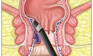 Фотокоагуляция для удаления геморроидальных узлов: эффективный метод лечения