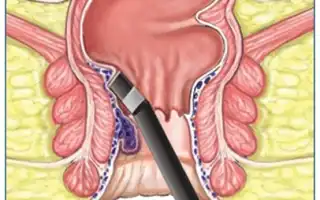 Фотокоагуляция для удаления геморроидальных узлов: эффективный метод лечения