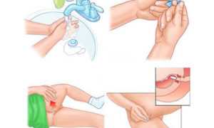 Свечи для лечения геморроя: эффективные методы и рекомендации