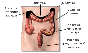 Как убрать каловые камни из кишечника в домашних условиях эффективно и безопасно