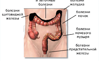 Как убрать каловые камни из кишечника в домашних условиях эффективно и безопасно
