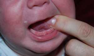 Понос из-за прорезывания зубов: длительность, причины и рекомендации