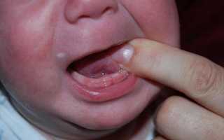 Понос из-за прорезывания зубов: длительность, причины и рекомендации