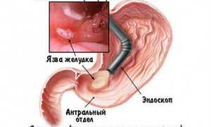 Антральный эрозивный гастрит: причины и лечение