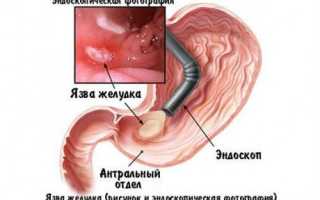 Антральный эрозивный гастрит: причины и лечение