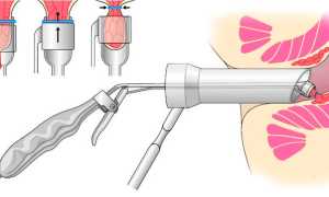 Как рожать женщинам с геморроем: советы и рекомендации