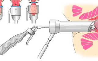 Как рожать женщинам с геморроем: советы и рекомендации