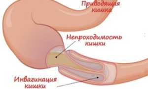 Непроходимость кишечника у детей: причины и лечение