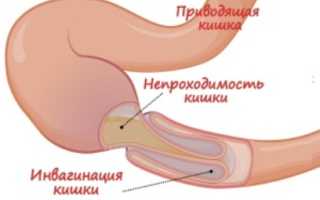 Непроходимость кишечника у детей: причины и лечение