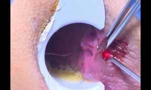 Как лечат геморрой лазером: современные методы и подходы