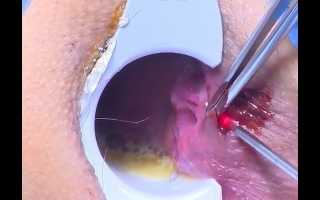 Как лечат геморрой лазером: современные методы и подходы