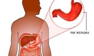 Лекарственные средства от хеликобактер пилори для эффективного лечения
