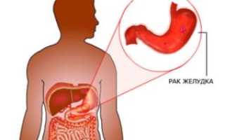 Лекарственные средства от хеликобактер пилори для эффективного лечения