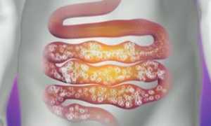 Вздутие, газообразование в животе: причины и лечение