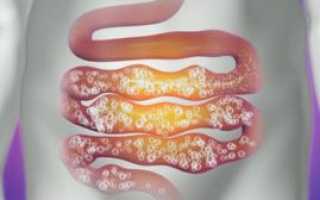 Вздутие, газообразование в животе: причины и лечение