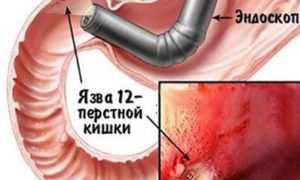 Язва 12-перстной кишки: причины и лечение