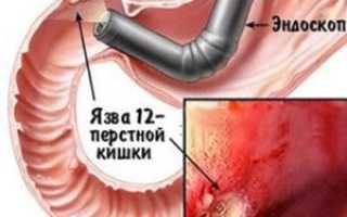 Язва 12-перстной кишки: причины и лечение