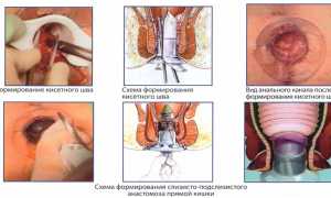 Лечение геморроя 2 степени: эффективные методы и рекомендации