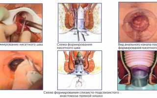 Лечение геморроя 2 степени: эффективные методы и рекомендации