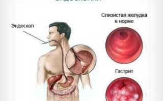 Как лечить гастрит правильно и эффективно