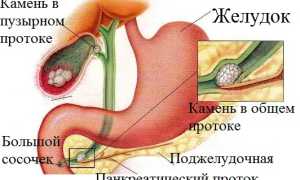 Что делать при поносе после удаления желчного пузыря: советы и рекомендации