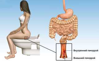 Боль в заднем проходе после опорожнения: причины и лечение