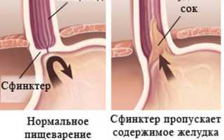 Изжога: что это, как устранить, причины и советы