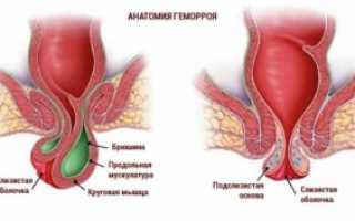 Геморроидэктомия по методу Миллигана-Моргана: особенности и преимущества