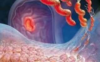 Эрозивная форма гастрита: причины и лечение