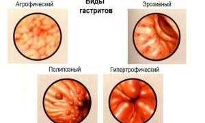 Лечение эрозивного гастрита: советы и рекомендации