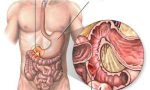 Кровь на туалетной бумаге после запора: причины и рекомендации