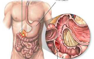 Кровь на туалетной бумаге после запора: причины и рекомендации