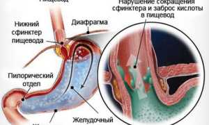 Народные средства от рефлюкс-эзофагита для здоровья