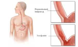 Что такое хронический рефлюкс-эзофагит и его симптомы