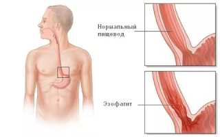 Что такое хронический рефлюкс-эзофагит и его симптомы