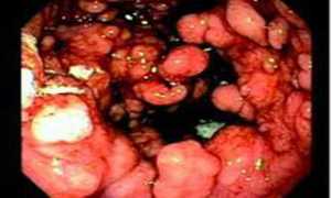 Гастрит гипертрофический: причины и лечение