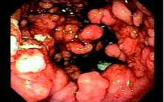 Гастрит гипертрофический: причины и лечение