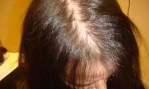 Хеликобактер пилори: как проявляется, чем лечить, советы и рекомендации