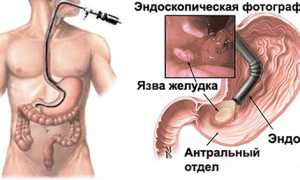 Как часто допускается делать гастроскопию для здоровья