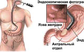 Как часто допускается делать гастроскопию для здоровья