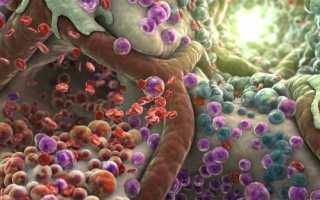 Симптомы интоксикации при запорах у взрослых пациентов