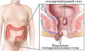 Геморрой: что это за болезнь, как выглядит и как с ним бороться