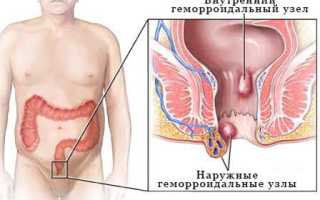 Геморрой: что это за болезнь, как выглядит и как с ним бороться
