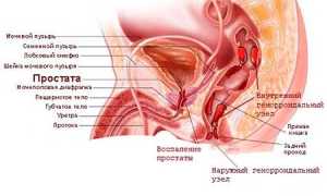 Влияет ли геморрой на мужскую потенцию и здоровье?